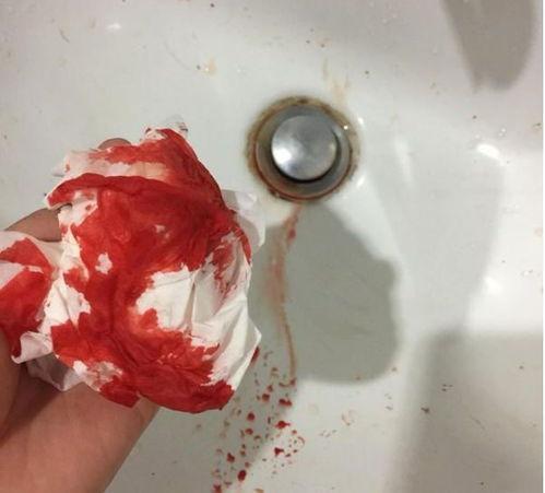 咳血图片,探寻健康警示的信号